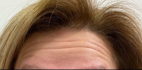 Forehead botox before and after