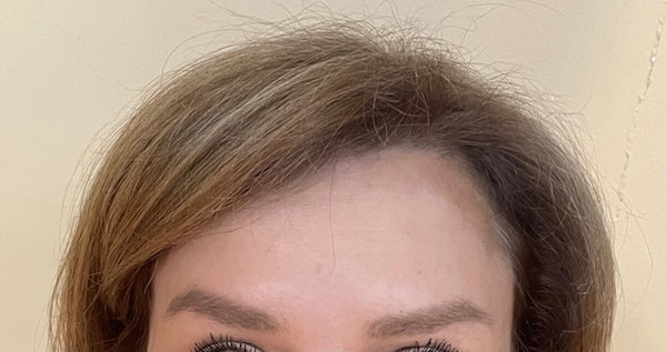 Forehead botox before and after