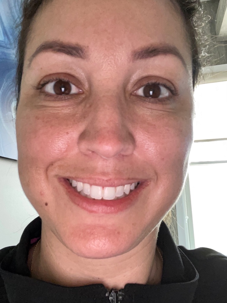 Gummy smile botox before and after