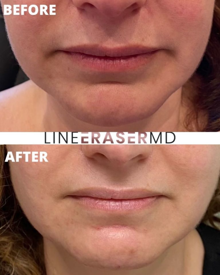 Chin Filler before and after