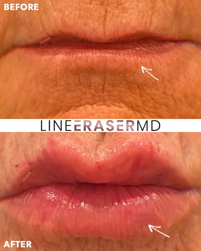 lip filler new jersey livingston before and after