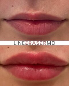 russian lips before and after