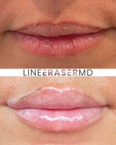 treatment russian lips