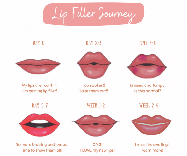 Lip filler Journey